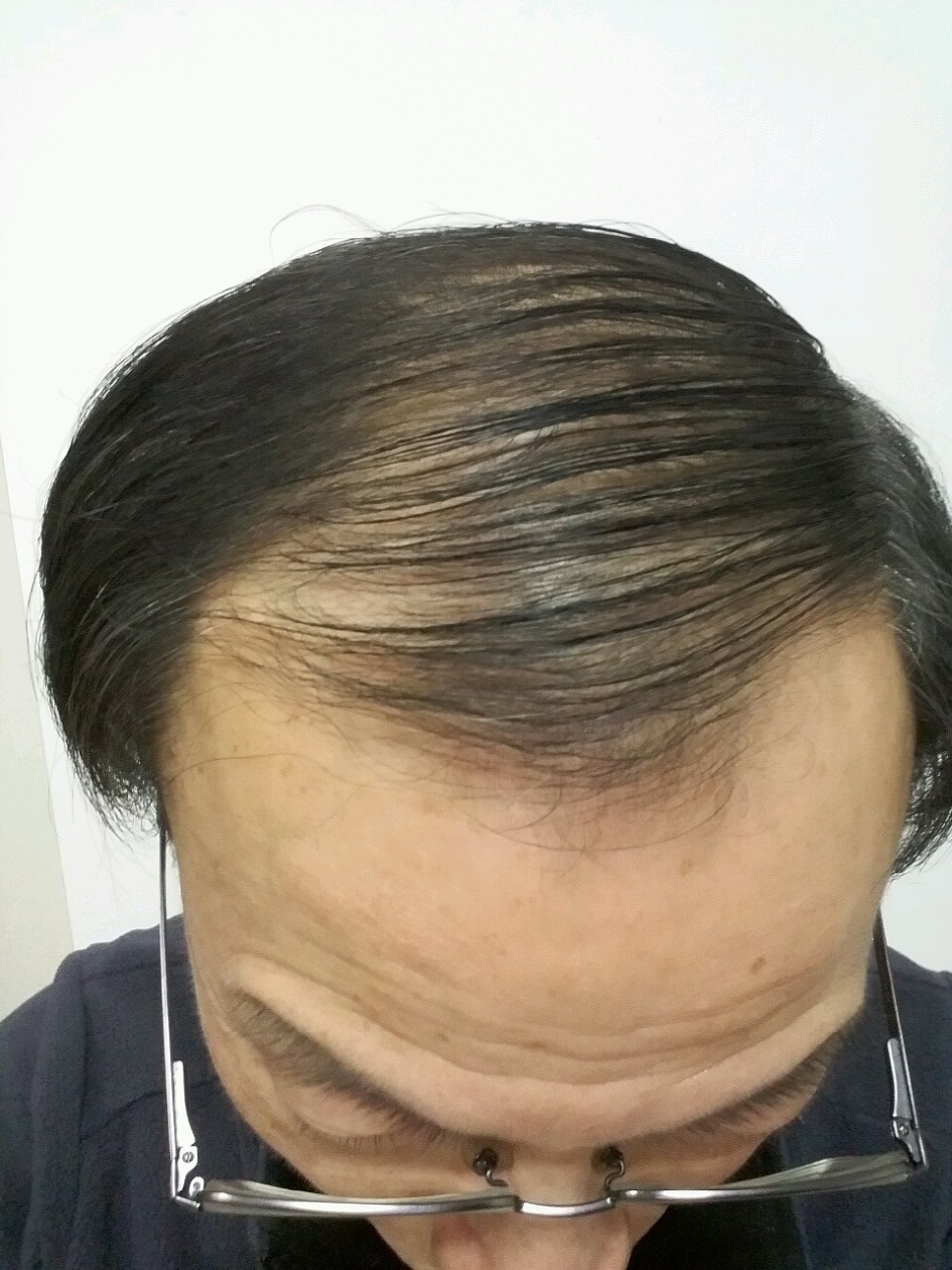 20년 탈모로 괴로웠던 세월을  이제 추억으로 .... 