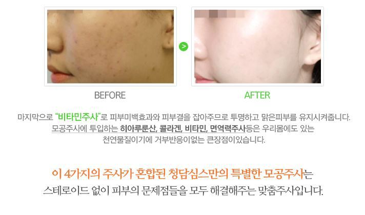 원주 피부과 모공을 작게 피부 탄력 살리다